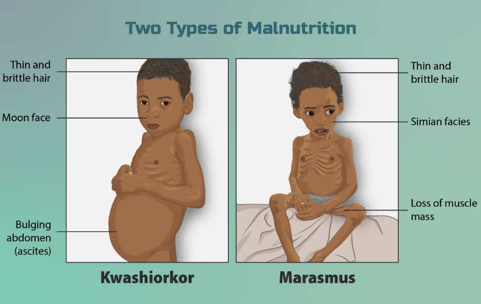 types of malnutrition